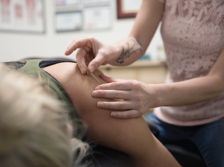 Technician performing acupuncture on a client